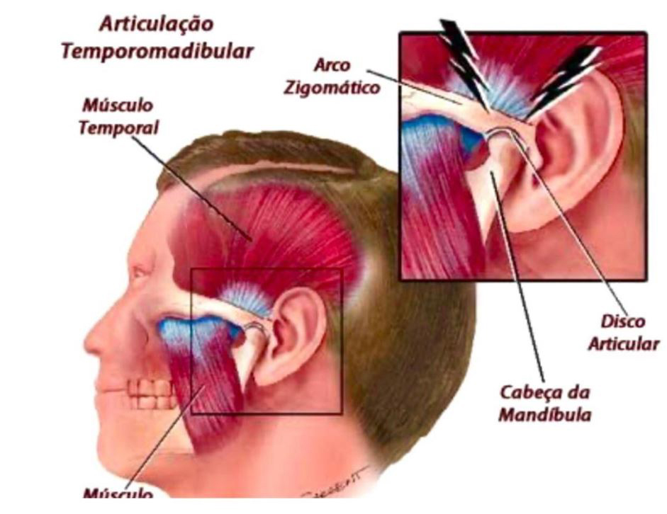 Clínica SportFisio - A sua mandíbula já travou? Geralmente isso acontece  como consequência do estresse, devido algum trauma ou em pessoas que têm  bruxismo e, num primeiro momento pode assustar pelo fato